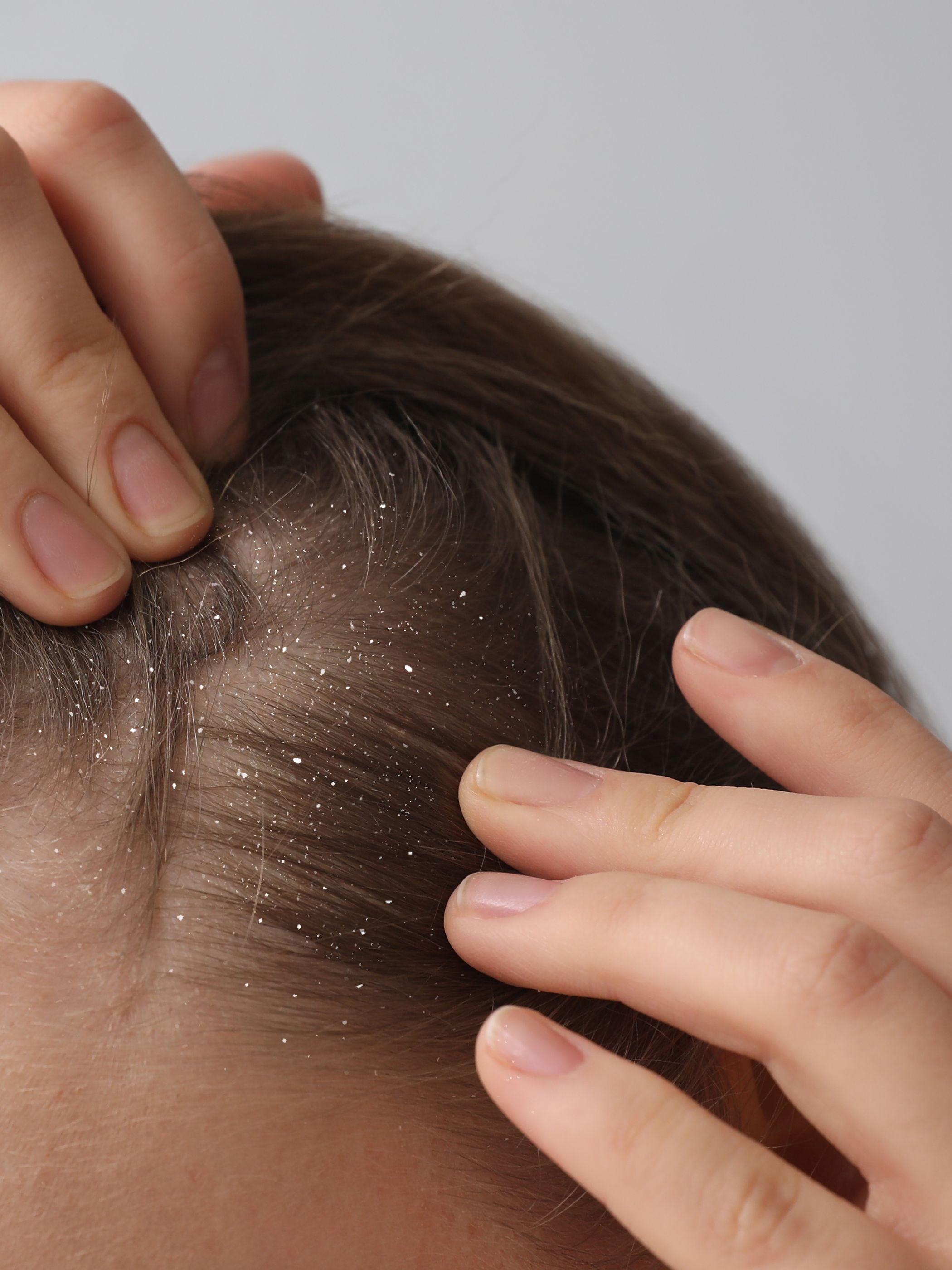 Tipps zur Vorbeugung und Behandlung von Kopfhautproblemen